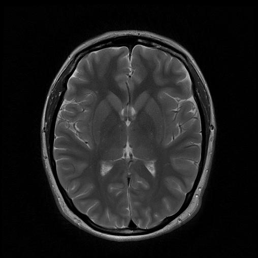 MRI scan of my brain